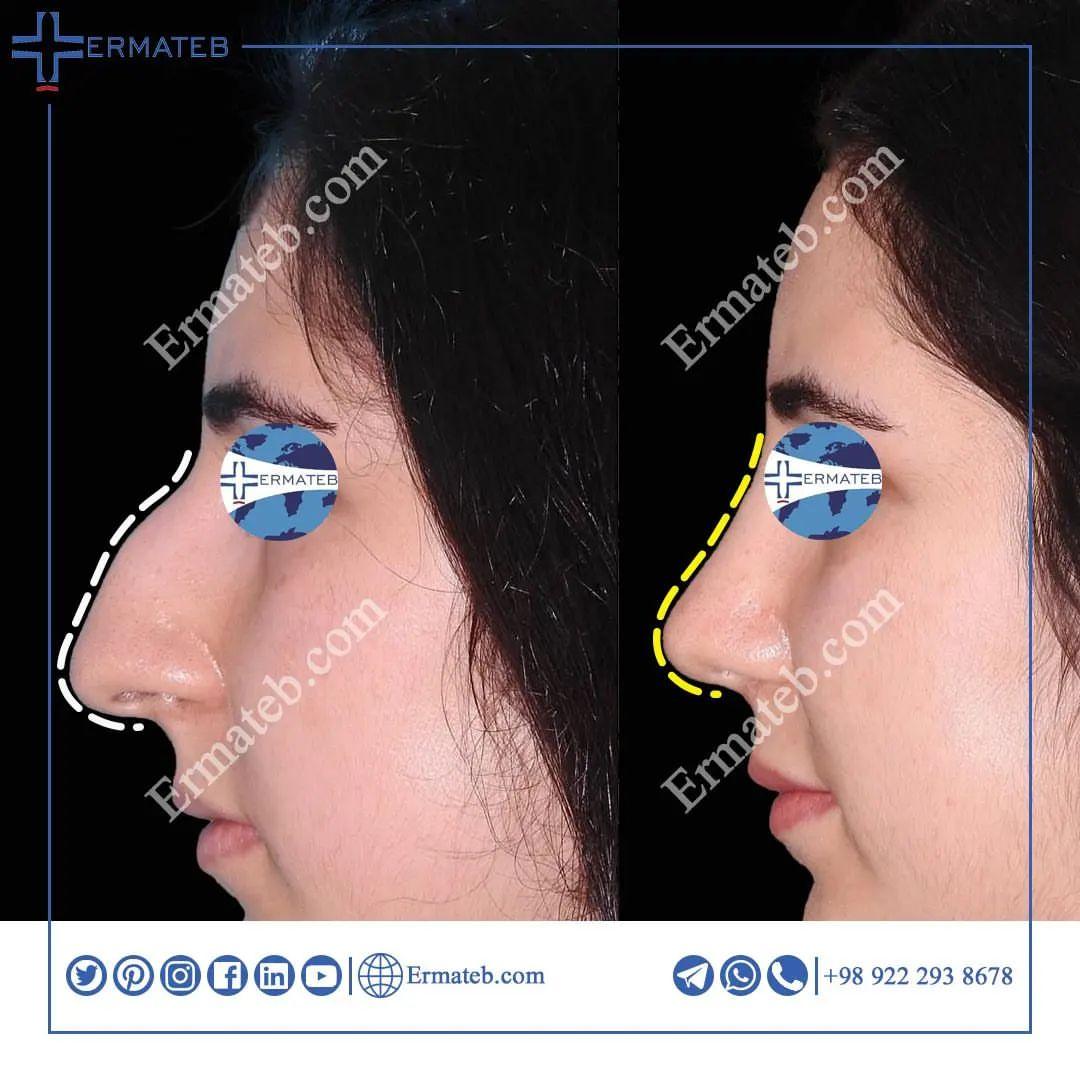ErmatebEn's tweet image. Rhinoplasty with just 1800$ 🤤😍
Free consultation: +98 922 293 8678
Website:en.ermateb.com
Whatsapp: api.whatsapp.com/send/?phone=98…