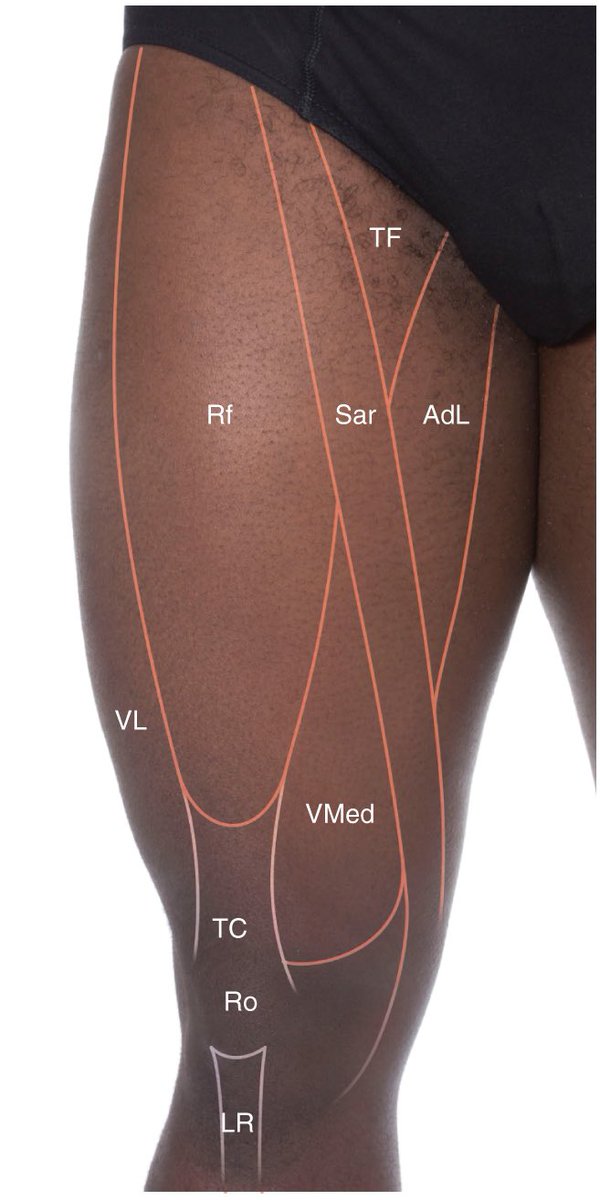 PasionAnatomia's tweet photo. Proyecciones en superficie cara anterior del muslo:
📌 AdL: m. aductor largo
📌 TF: triángulo femoral
📌 Ro: rótula
📌 LR: ligamento rotuliano
📌 TC: tendón del m. cuádriceps femoral
📌 Rf: m. recto femoral
📌 Sar: m. sartorio
📌 VL: m. vasto lateral
📌 VMed: m. vasto medial https://t.co/lIHDYo4882
