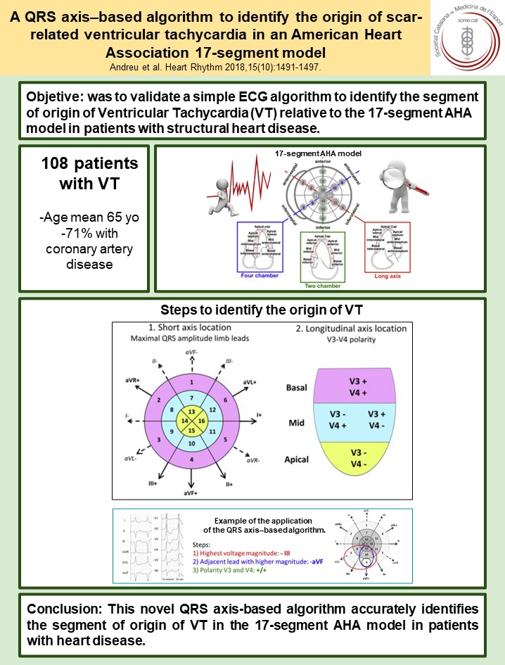 Ventricular Tachycardia Algorithm