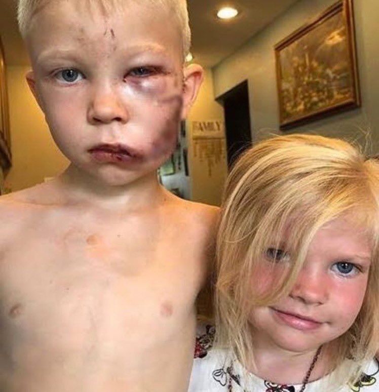 Dünya Boks Konseyi, kız kardeşini köpek saldırısından koruyan ve köpekle boğuştuktan sonra yüzüne yaklaşık 90 dikiş atılan Bridger Walker'ı "Dünya Şampiyonu" ilan etmiş..👏🏻👏🏻