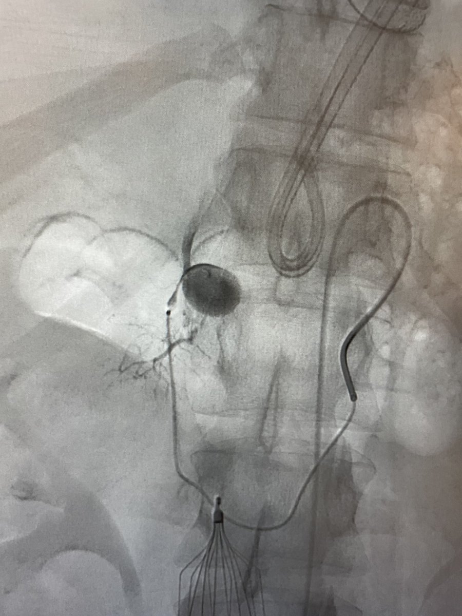 doctorsafranzak's tweet photo. حالة نزيف في الامعاء لمريض تم ايقاف النزيف بنجاح ولله الحمد بالقسطرة باستخدام ادواة جديدة Caterpiller https://t.co/MOfsCdroD9