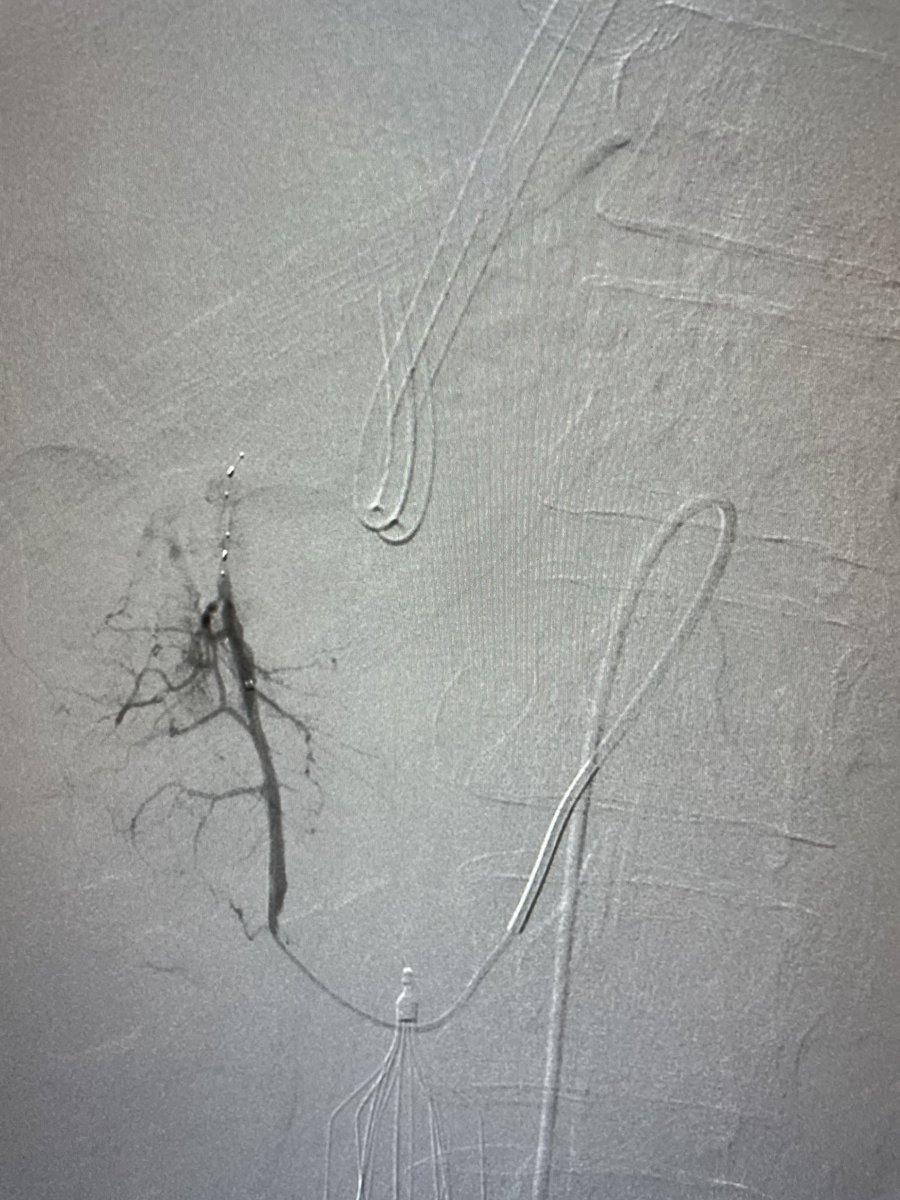 doctorsafranzak's tweet photo. حالة نزيف في الامعاء لمريض تم ايقاف النزيف بنجاح ولله الحمد بالقسطرة باستخدام ادواة جديدة Caterpiller https://t.co/MOfsCdroD9