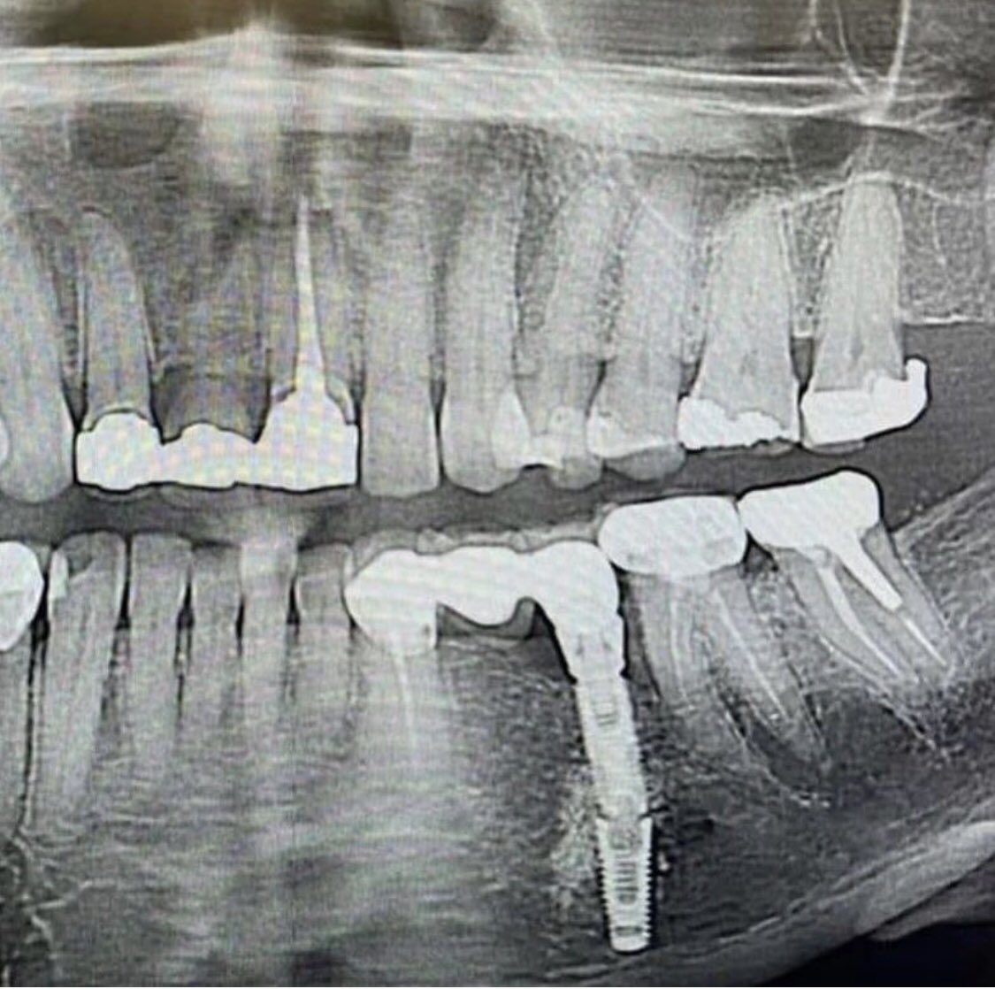 Dubleks implant 🤔