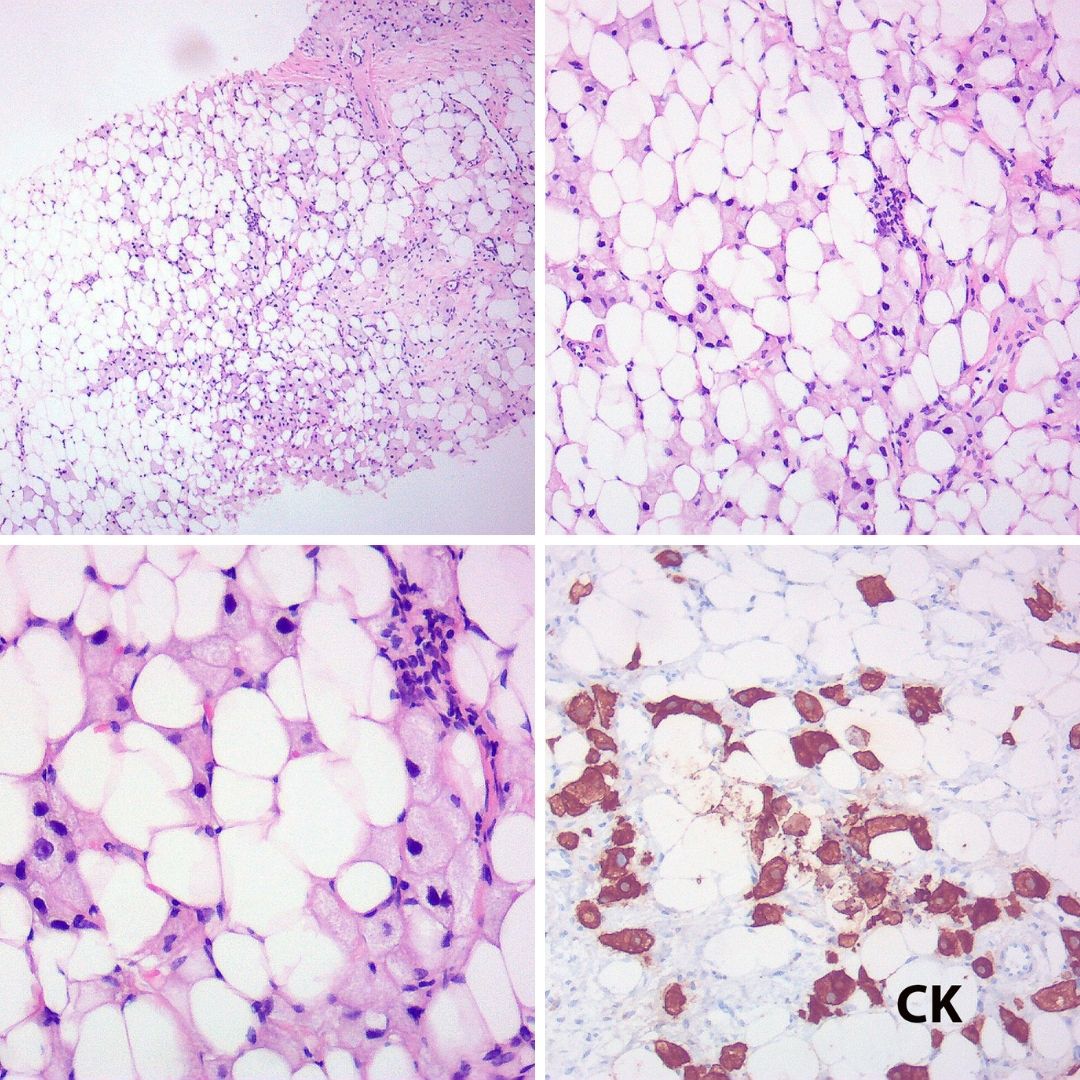 GeronimoJrLapac's tweet photo. A carcinoma without a bad face - A trap!  
Invasive breast carcinoma (e-cad +) with histiocytoid cells mimicking steatonecrosis... atypia is the clue and if doubt persists in these cases a CK helps!

#breastpath #pathology https://t.co/1hm1aINlOL