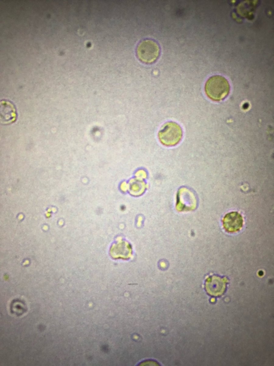msc271's tweet photo. 77M w/HTN, BPH, GERD who presents as a transfer from OSH for higher level of care after discovery of necrotizing granulomatous inflammation & fibrosis without any organisms on lung Bx. #UrinarySediment, #UrineMicroscopy +ANCA, +PR3, #acanthocytes https://t.co/q7g1NNiVLm