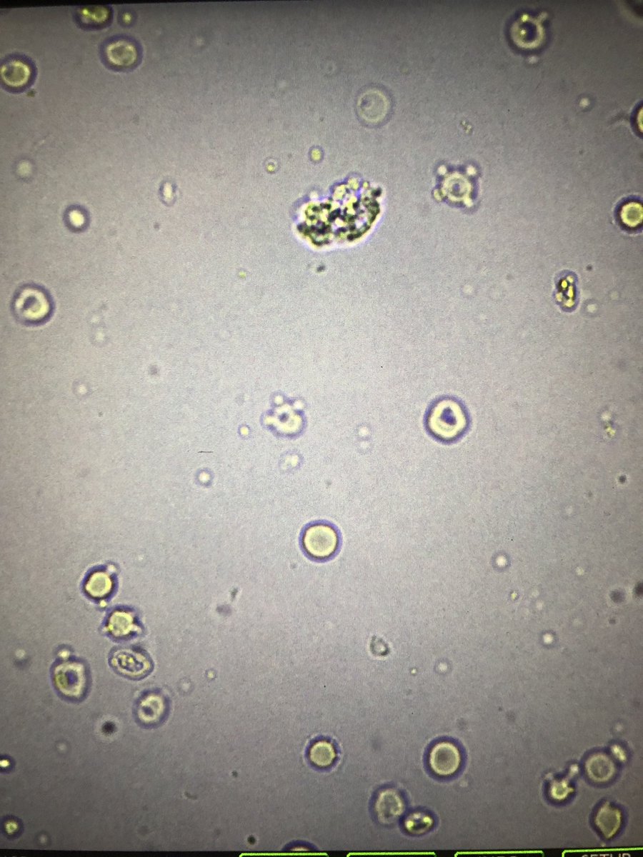msc271's tweet photo. 77M w/HTN, BPH, GERD who presents as a transfer from OSH for higher level of care after discovery of necrotizing granulomatous inflammation & fibrosis without any organisms on lung Bx. #UrinarySediment, #UrineMicroscopy +ANCA, +PR3, #acanthocytes https://t.co/q7g1NNiVLm