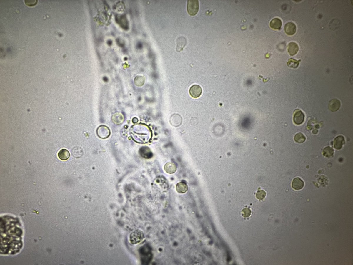 msc271's tweet photo. 77M w/HTN, BPH, GERD who presents as a transfer from OSH for higher level of care after discovery of necrotizing granulomatous inflammation & fibrosis without any organisms on lung Bx. #UrinarySediment, #UrineMicroscopy +ANCA, +PR3, #acanthocytes https://t.co/q7g1NNiVLm