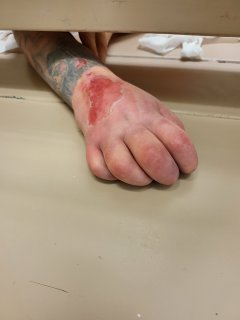 PLZ RT: Inmate Greg Corely has an untreated infection in his arm. It is very likely he will now lose it. 
Support <a href="/DentonBailFund/">Denton Bail Fund</a> efforts to save Greg's life before the infection spreads! 
Protest Wed 7/13 at 6PM at <a href="/DentonCountyTX/">Denton County, Texas</a> Jail
Call/email Toolkit: bit.ly/GregCorley