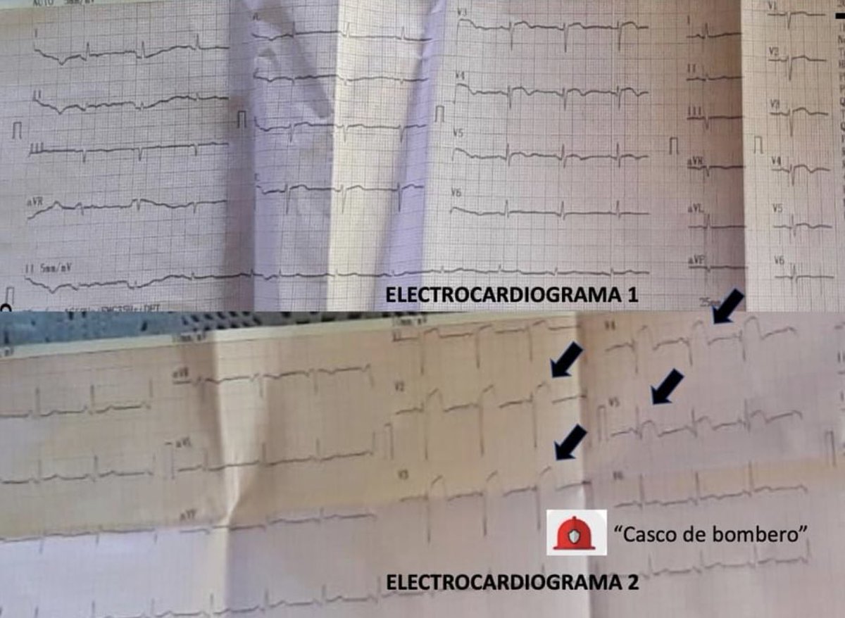 😪😔😔😔El infarto Agudo al miocardio continúa siendo la causa 1 de muerte! Más que #COVID19! facebook.com/53825850954534… #infarto