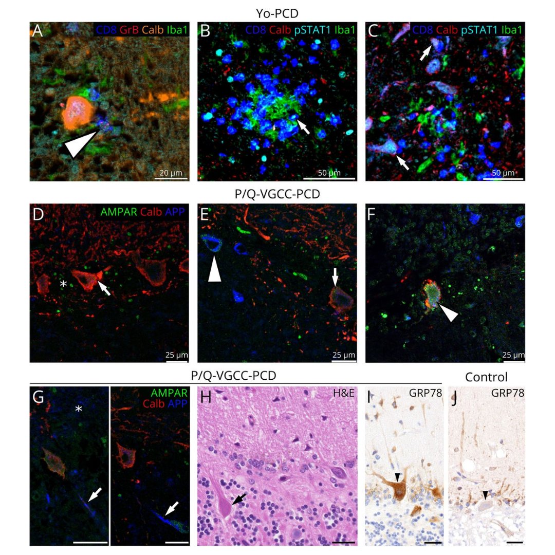 GreenJournal's tweet photo. This study compares neuropathologic characteristics of PCD with anti–P/Q-VGCC and anti-Yo autoantibodies in an archival autopsy cohort. Read the open access article now: https://t.co/8pEYq8ANMu #Neurology #NeuroTwitter https://t.co/Typ1XacThN