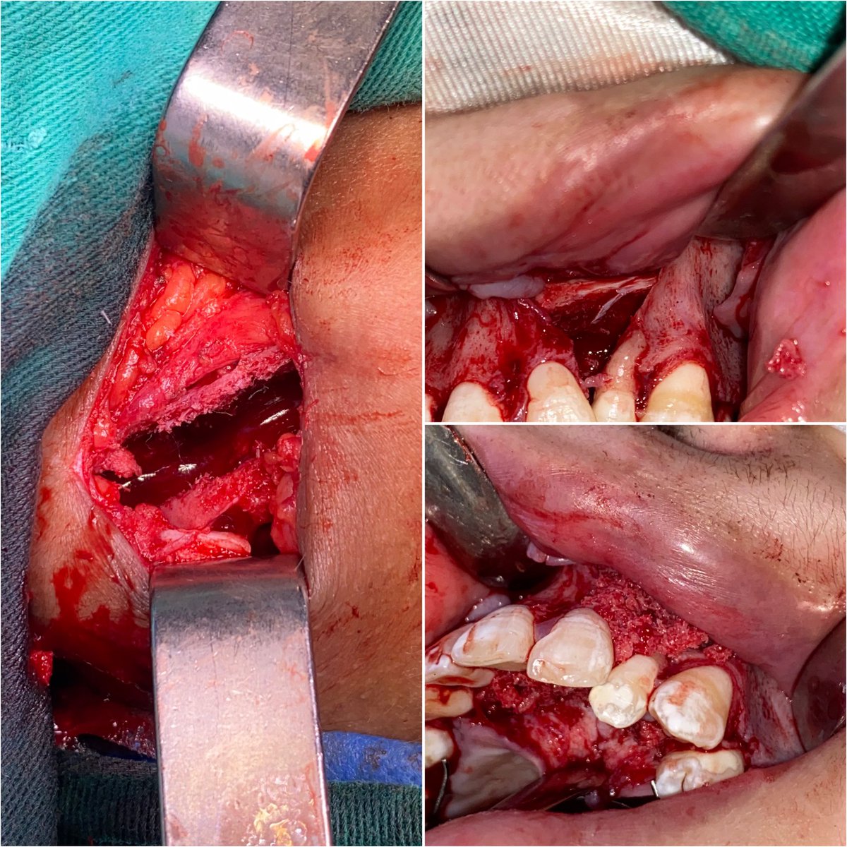 Injerto autólogo de cresta ilíaca derecha + Obtección de 20 cc de hueso cortico esponjoso + Correción de defecto óseo por secuela de fisura labio alvéolo palatina ipsilateral.
