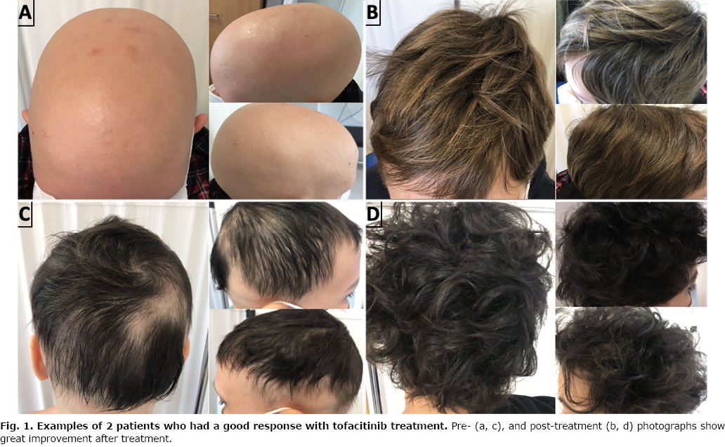 A new paper:
Tofacitinib for Treatment of Alopecia Areata: Real-world Evidence and Factors Associated with Therapeutic Response
#Tofacitinib #AlopeciaAreata #RealworldEvidence #TherapeuticResponse
doi.org/10.2340/actadv…