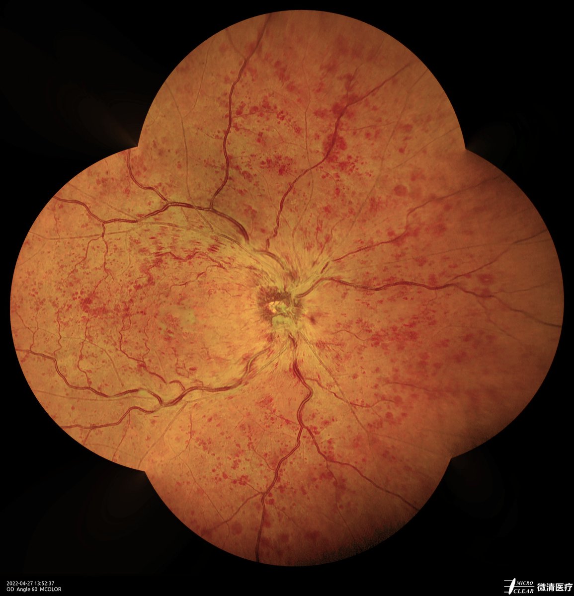 #CRVO #centralretinalveinocclusion
Pictured by Apollo the #confocalretinalophthalmoscope
#retinopathy #angiography #autofluorescence #icga #fluoresceinangiography #funduscamera #ophthalmology #ophthalmic