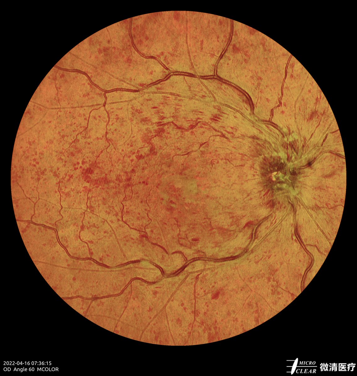 Microcleartec's tweet photo. #CRVO #centralretinalveinocclusion
Pictured by Apollo the #confocalretinalophthalmoscope
#retinopathy #angiography #autofluorescence #icga #fluoresceinangiography #funduscamera #ophthalmology #ophthalmic https://t.co/HCNPS0VUhr