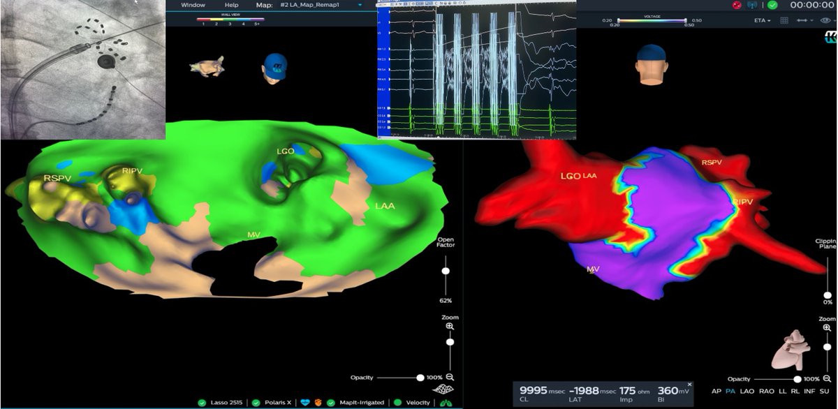 FilippoCauti's tweet photo. PFA lesions across the different left atrium wall thickness. Are we there yet? #KODEXepd @farapulse  @bostonsci #Epeeps @sommer @PhilipsHealth @PhilipsItalia #fbfteam @stefbianchi @PietroRossiEP https://t.co/kzxRP6mZHD