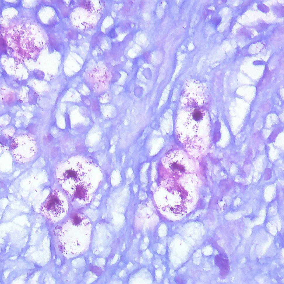 ⚠️ Don't overlook a seemingly simple case. You can have the surprise of a combo! 🎯 BCC + LEPROSY #dermpath #pathology