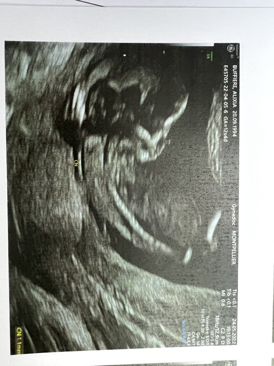 Baby Elisa ❤️👶🏻
Dec. 11
#MumToBe