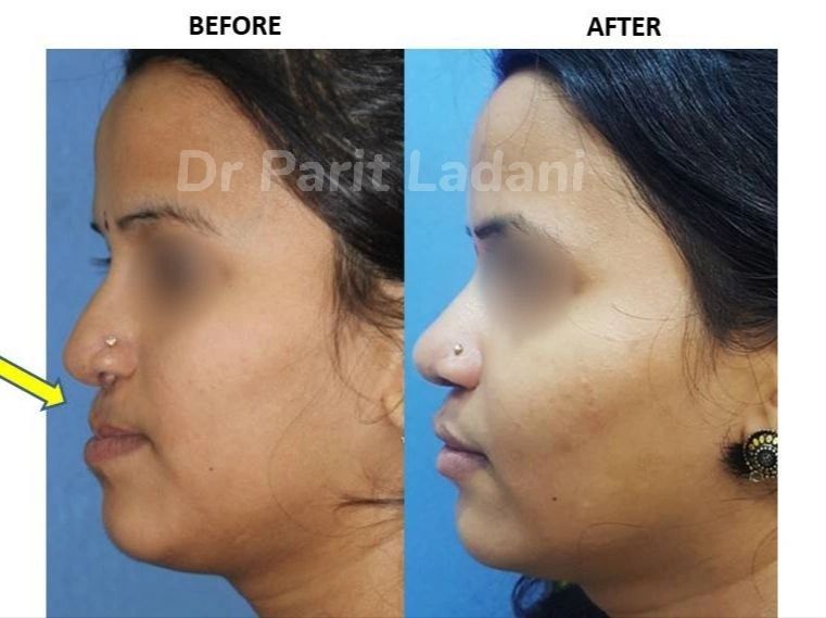 𝗝𝗮𝘄 𝗖𝗼𝗿𝗿𝗲𝗰𝘁𝗶𝗼𝗻 𝗦𝘂𝗿𝗴𝗲𝗿𝘆

Click here to in a detail about Jaw Correction Surgery 👇🏻👇🏻
cleftsurgerymumbai.in/corrective-jaw…

{For appointment : +91-9867472415}

#jawsurgery #orthognathicsurgery #lefort1 #bijawsurgery #plasticaurgery #chinsurgery #genioplasty