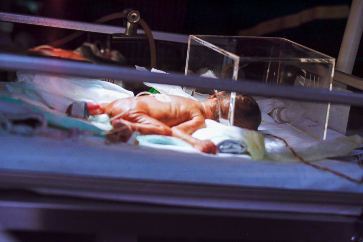 Sedation for less invasive surfactant administration in preterm infants: a systematic review &amp; meta-analysis
rdcu.be/cRnVC (free to access) 

This work assesses impact of sedative drugs compared to no-sedation for LISA on short-term pulmonary outcomes &amp; adverse events