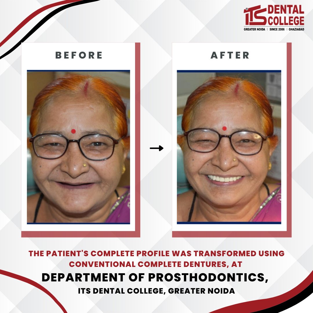 The patient's complete profile was transformed using conventional complete dentures, 
At the Department Of Prosthodontics, ITS Dental College, Greater Noida.
.
#ITSDentalCollege #Prosthodontics #HappyPatientHappyUs #OralRehabilitation #CompleteDentures #Dentures #Prostho