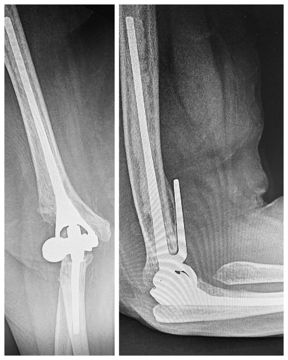 3️⃣ años postoperatorio
▪️Artroplastia total de codo (tipo bisagra) en el tratamiento de fractura supra-intercondilea humeral
▪️🚺 77 años
▪️Artroplastia Latitude EV Cementada