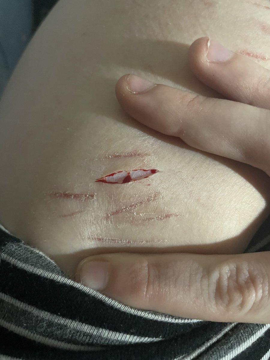 sliceydiceydes's tweet photo. Yummmy #twsh #twselfharm https://t.co/i6a0mxgkH2