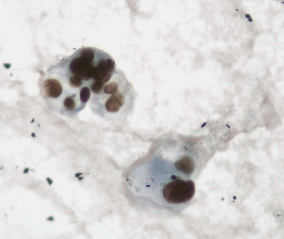 "Two-in-one": lung AC in a pleural effusion: the same cells stained with papanicolaou and then with TTF1. 
"Cytopathology, doing more with less...."🔬✌️🎯💯🔝
<a href="/SECitologia/">Sociedad Española de Citología</a> <a href="/SEAP_IAP/">SEAP-IAP</a> <a href="/cytopathology/">Cytopathology.org</a> <a href="/IACytology/">International Academy Cytology</a>