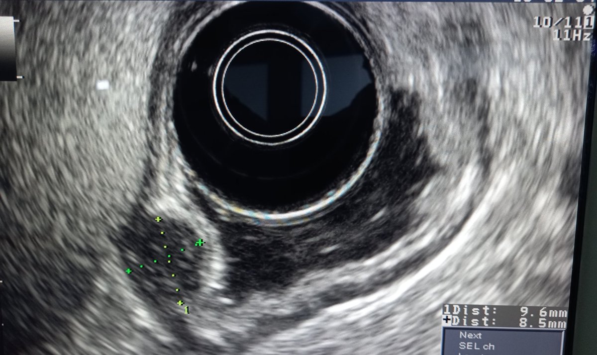 #GItwitter gastric subepithelial lesion in the antrum less than 1 cm with this appearance in endosonography. What is your diagnosis and approach?