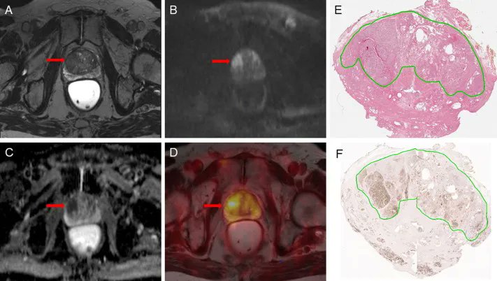 EUplatinum's tweet photo. August 2022 Issue

Radical Prostatectomy Without Prior Biopsy Following mpMRI and PSMA PET https://t.co/8cjBabCQf0 

Editorial: Radical Prostatectomy Without Biopsy: Audacious, Imprudent, or Innovative? https://t.co/TyruYKziXr https://t.co/EsjU5ndKVl