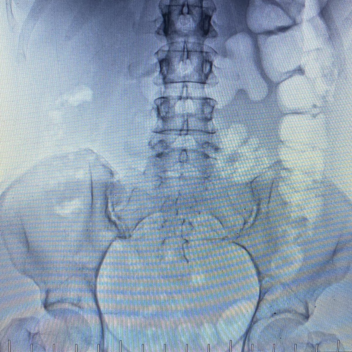 DidYouAskDad's tweet photo. So thankful it is now acceptable to share uterus photos! Here’s a photo of mine and an IUD floating in my abdomen. Take care of yourself ladies. This could’ve been another miscarriage. Looks like it wasn’t stress doing weird things to my body these last 2 years as previously told https://t.co/nUGAwQE6z3