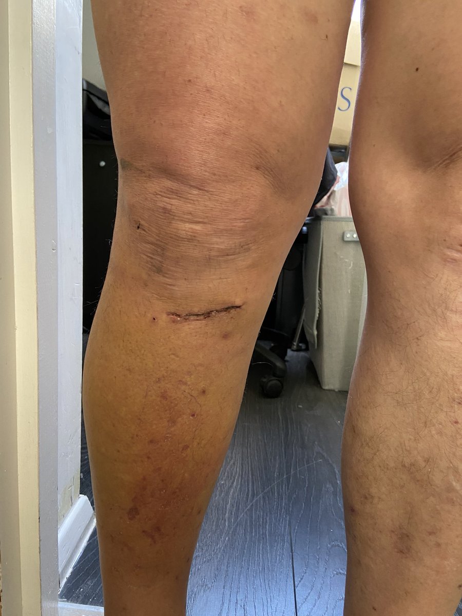 Comsky76's tweet photo. Recovery going well! #tibialosteotomy https://t.co/iB1pLIkDzX