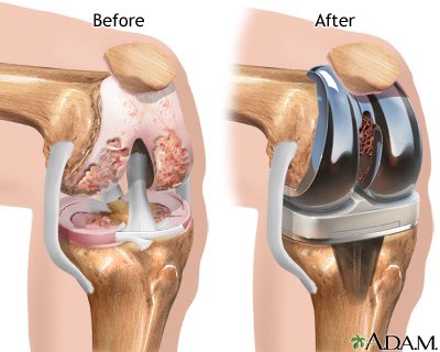 Knee replacement its done!!! Surgery went super well!!