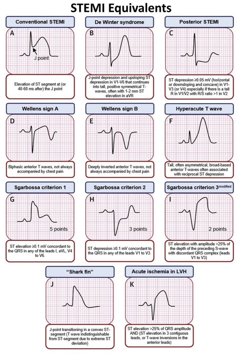 Nice reminder of #STEMI equivalents and why the paradigm is changing to occlusion myocardial infarction #OMI 

#FOAMed #FOAMcc #MedEd #MedTwitter #ECG #EKG