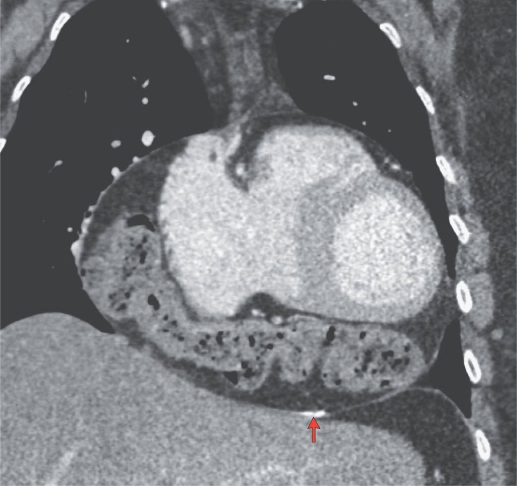 This patient had palpitations that were relieved by bowel movements and passing gas. 

It is possible for the COLON to end up in the pericardium 🤯

#MedTwitter