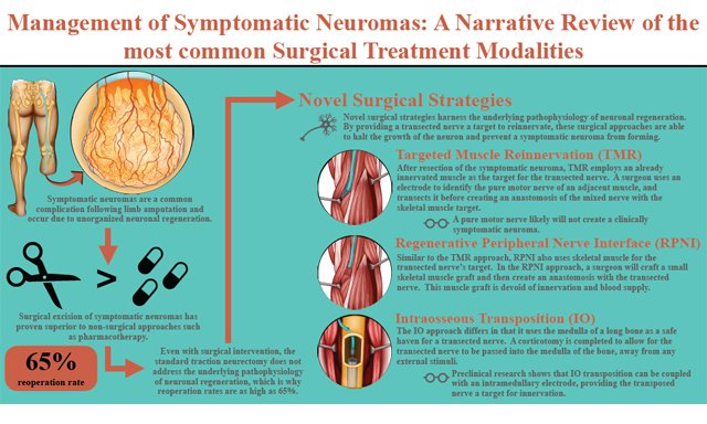 PARjournal's tweet photo. #Neuromas #Targeted muscle reinnervation
Dr. Samuel O. Poore's team present an excellent Review entitled: Management of symptomatic neuromas: a narrative review of the most common surgical treatment modalities in amputees.
Online: https://t.co/ScuxEMHnxT
Welcome to share it! https://t.co/zytQ5Fa9Y5