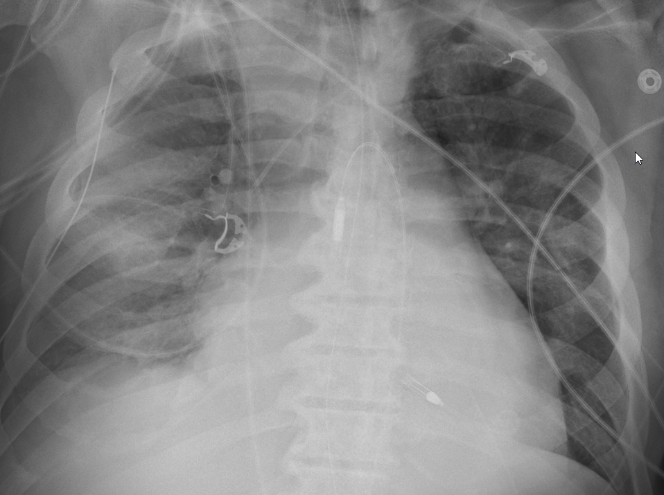 ICU stories: Eldelry pt w CAD s/p multi-vessel PCI / DM2 / HTN presented to the ED w epigastric "bur...