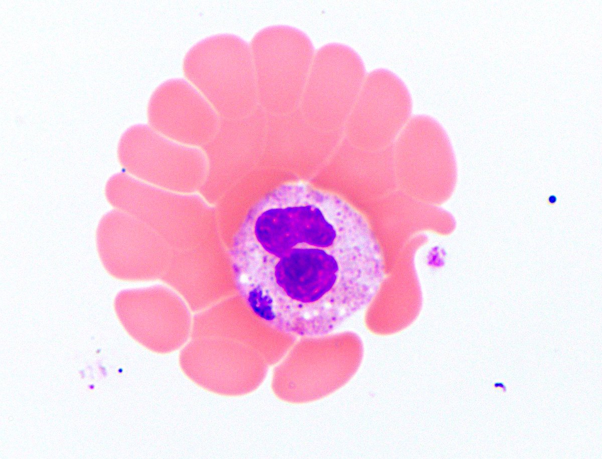 NYUGSOMpathres's tweet photo. Time for the first #PathTwitter case of the academic year! A patient presented with high fever, malaise, and weakness, no rash seen. They report hiking upstate NY a few weeks prior. Labs w/ โฌ๏ธ platelets, leukopenia and โฌ๏ธ LFTs. A buffy coat smear is shown. Any thoughts? #pathbugs https://t.co/RohLy2rx5x