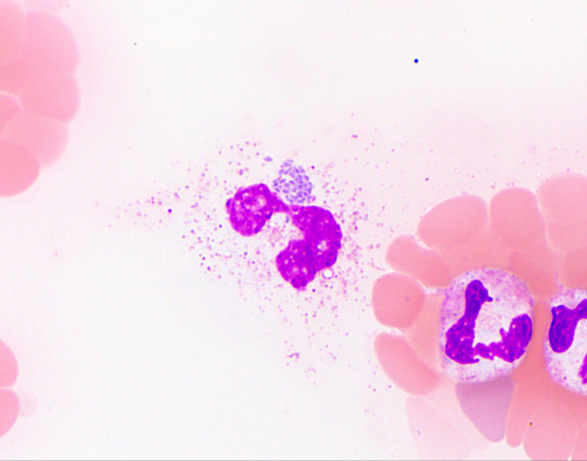 NYUGSOMpathres's tweet photo. Time for the first #PathTwitter case of the academic year! A patient presented with high fever, malaise, and weakness, no rash seen. They report hiking upstate NY a few weeks prior. Labs w/ โฌ๏ธ platelets, leukopenia and โฌ๏ธ LFTs. A buffy coat smear is shown. Any thoughts? #pathbugs https://t.co/RohLy2rx5x