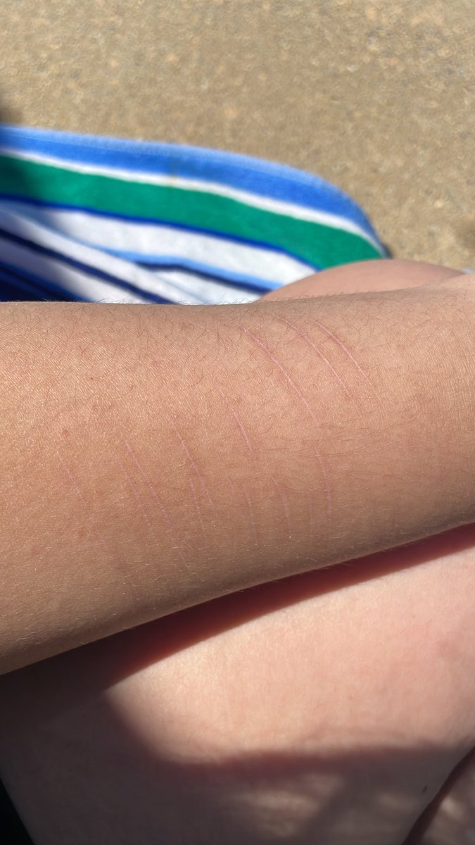 cloudy67903574's tweet photo. the few scars on my arm >>>

i think they look so pretty <3 https://t.co/oRZ0qT66a8