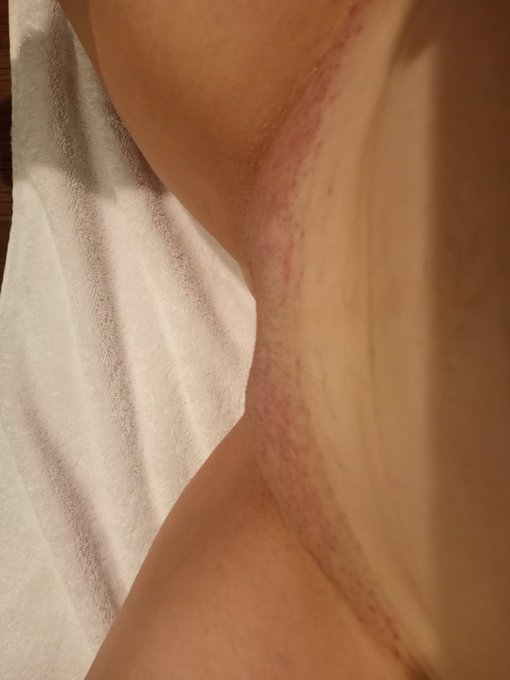 OMG. Can you see?  THIS. IS. WHY. I. HATE. SHAVING.  in grown hairs but the WORST is razor bumps and<a href="/tag/manyvids"class="tags"><span>#manyvids</span></a>