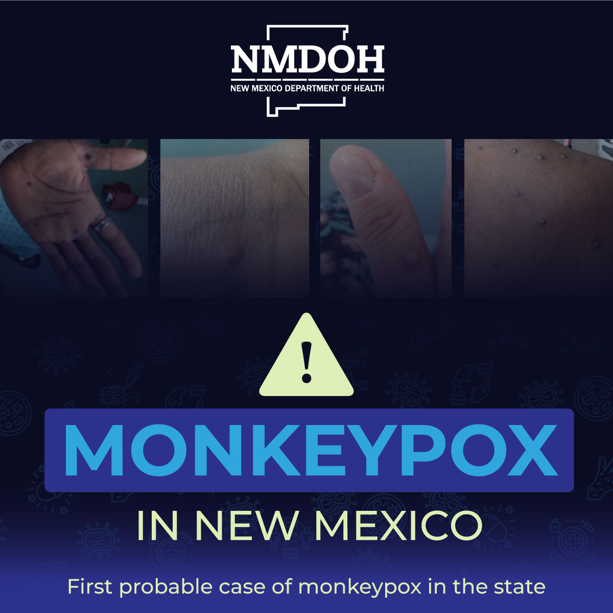 NMDOH reports the 1st probable case of monkeypox in NM. Initial testing was completed late 7/8 by the Scientific Laboratory Division and confirmed testing is being completed at CDC. The individual is doing well and isolating at home.