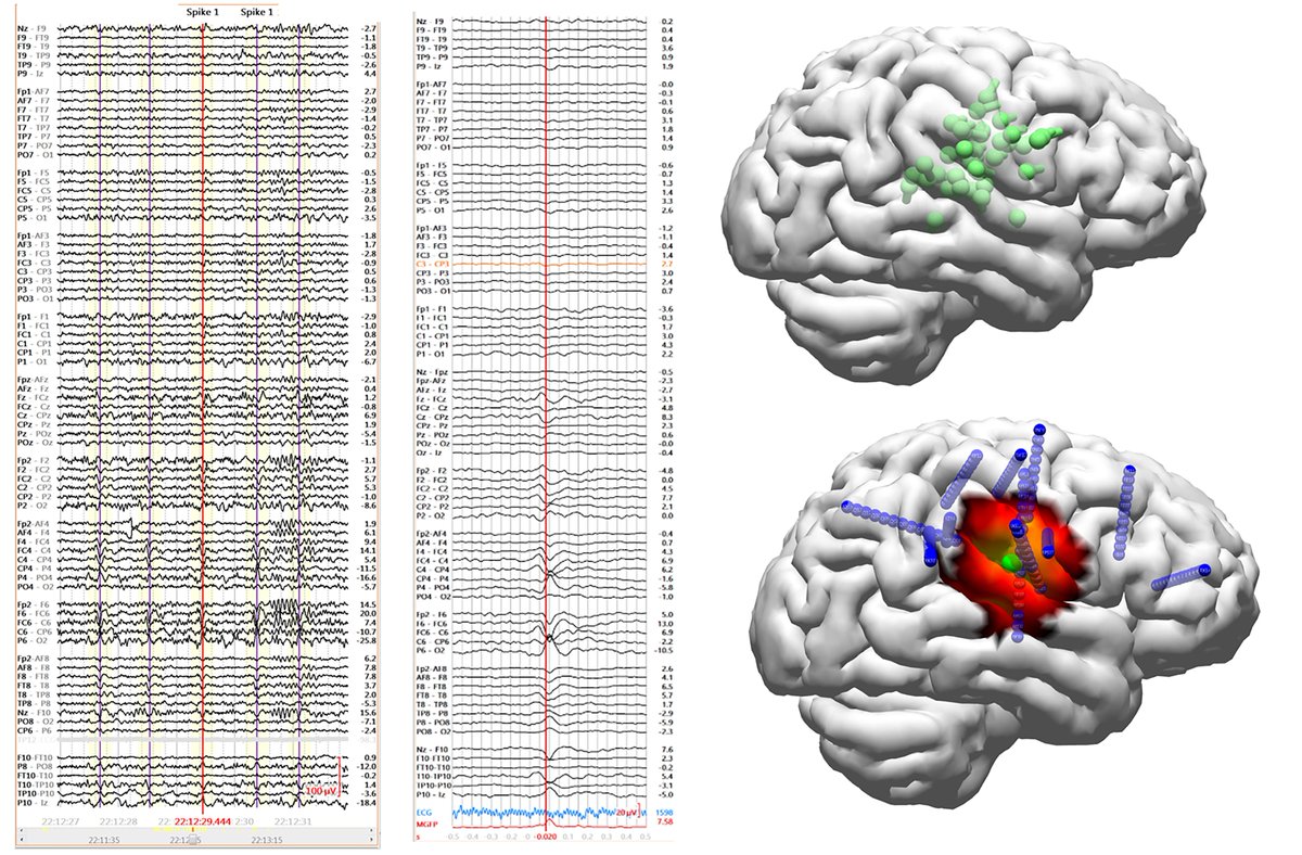 EpilepsiaJourn's tweet photo. From Theory to Practical Fundamentals of EEG Source Imaging in Localizing the Epileptogenic zone https://t.co/4Cy3Ffkigg
#epilepsy #epilepsyresearch #EEG #Headmodel #Inversemodel #Epileptogeniczone #sourceimaging @IlaeWeb @WileyNeuro @yesILAE @EpilepsiaJourn https://t.co/THdxLWs3vi
