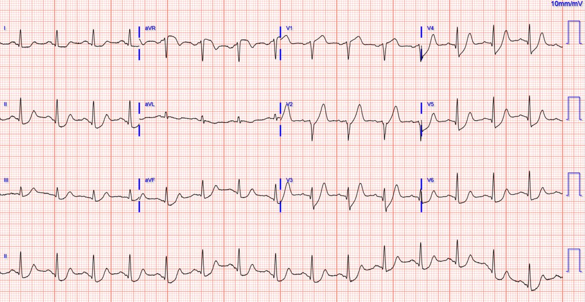 Instant easy save if you understand OMI, but incredibly dangerous if you only know STEMI. Readers of this blog will instantly understand this and save lives!  <a href="/PendellM/">Pendell Meyers</a> 

hqmeded-ecg.blogspot.com/2022/07/instan…