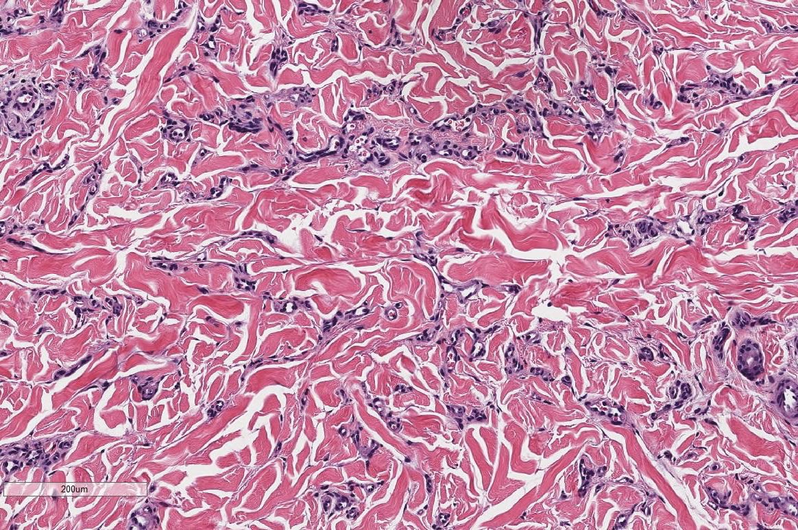 Cute little vascular lesion on the thigh of a young person—this is a microvenular hemangioma. #dermpath #pathology #dermatology #dermtwitter #pedipath