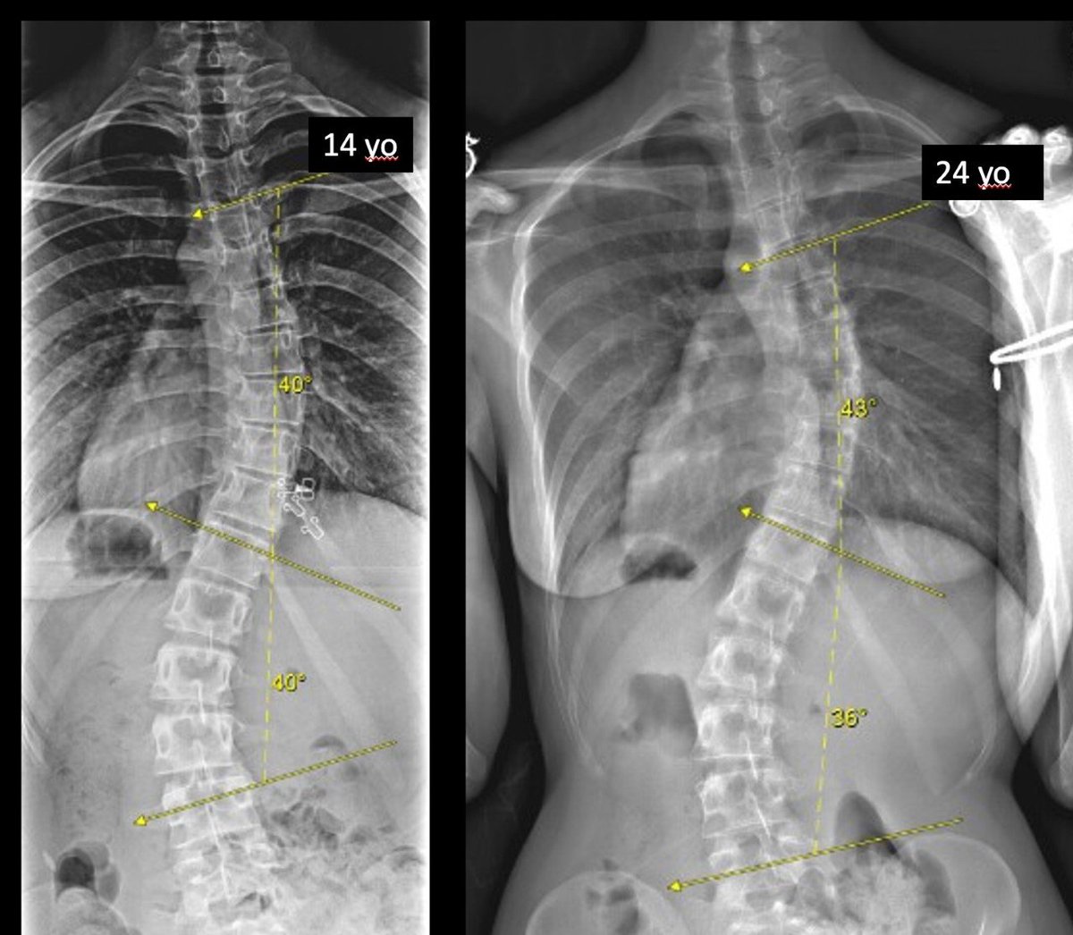 dr_skaggs's tweet photo. Successful Bracing of Scoliosis. I saw this patient 10 years ago &amp; she wore a brace for 2 years. She is now 24 years old. It was a highlight of my day! #scoliosis #spine #orthotwitter #orthomed https://t.co/h8rQTK97Fy