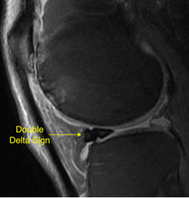 EMNews's tweet photo. A #meniscus shaped like a bowtie? Normal. One shaped like a #doubledelta? Uh-oh. @L_swish explains how she treated a patient whose knee was locked at a 90-degree angle. #FOAMed https://t.co/AvTfKEsch4 https://t.co/VMszAsLUgf