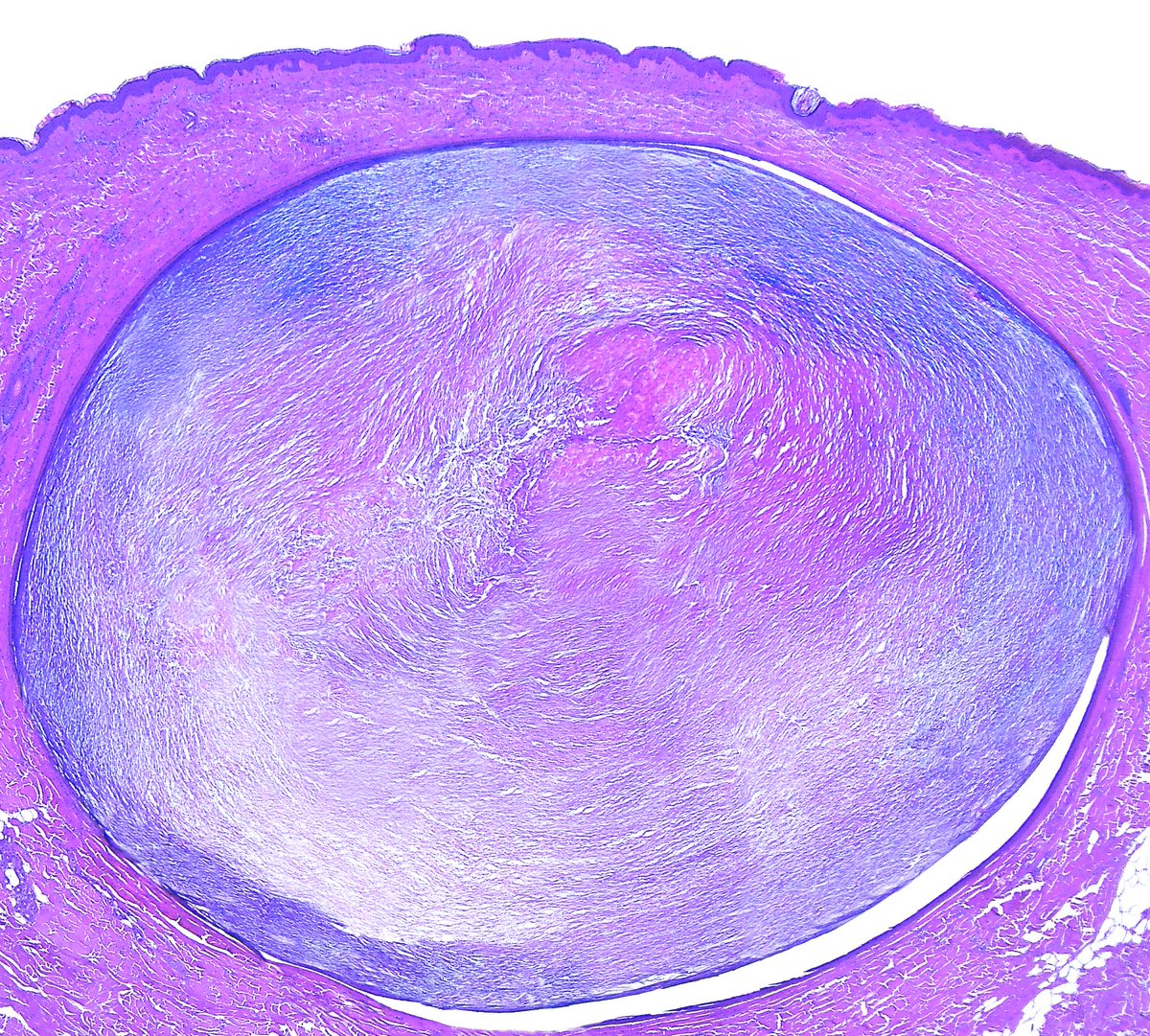 Patholwalker's tweet photo. Epidermal cyst. #Pathology #Pathologist #DermPath #PathArts https://t.co/jSwhnI9VwV