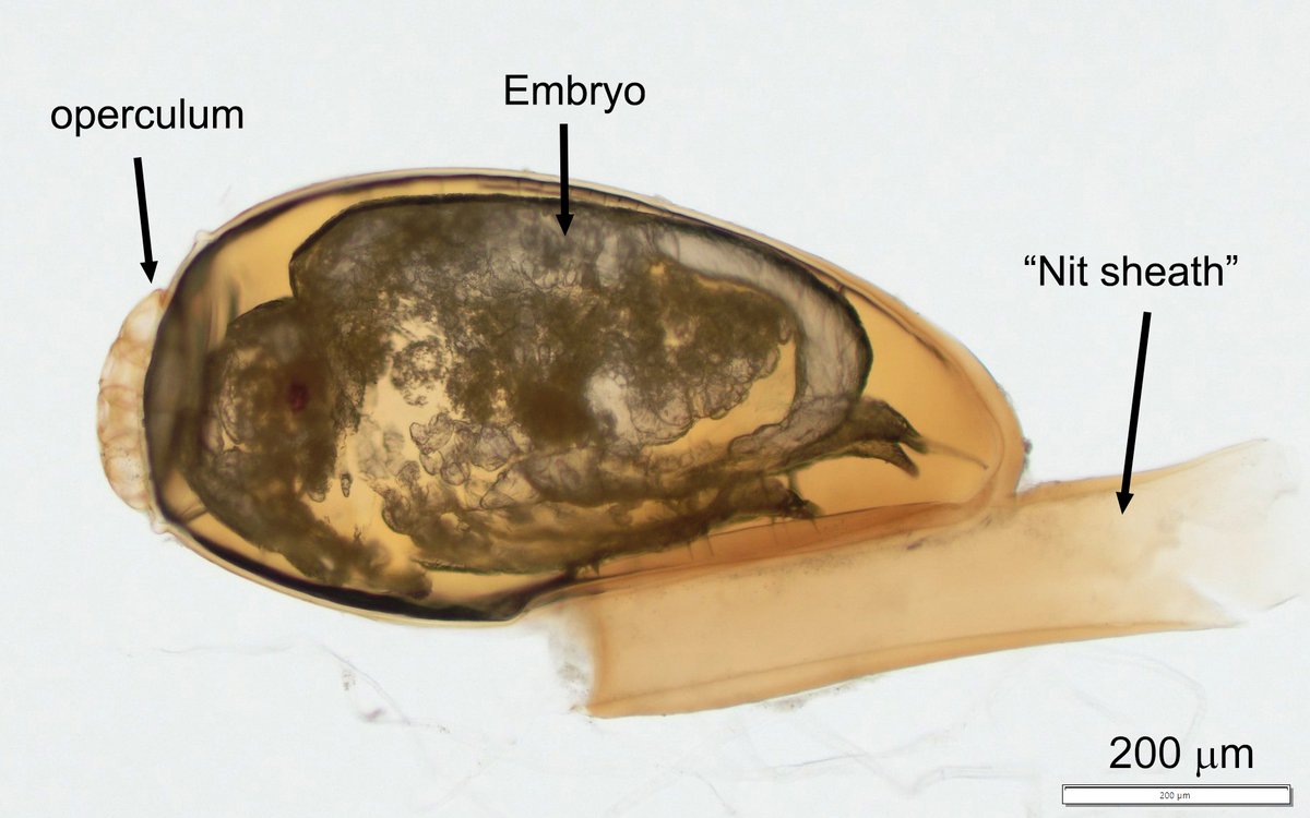 ParasiteGal's tweet photo. The answer to #Parasite Case 688 is up: head louse egg. Check out the legs on the embryo inside 😮.
https://t.co/WOSqwMDewf 

#mayopath #pathology #path2path #MayoClinMicro #CrittersonTwitter #PathBugs https://t.co/TxX9SCBeC4