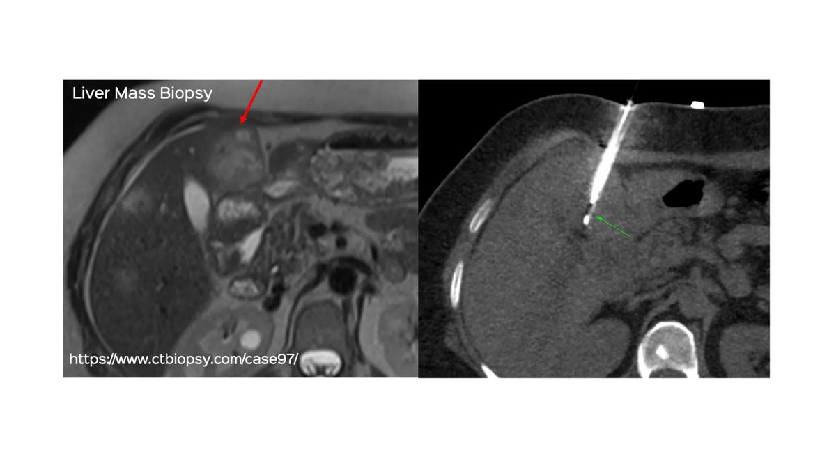 Case 97: Liver Mass Biopsy

Multiple liver lesions & pancreatic body mass. Bx of segment 4B mass. Simple and straightforward.

Post and video
ctbiopsy.com/case97/

#ctbiopsy #irrad #liver #livermass #livermetastasis