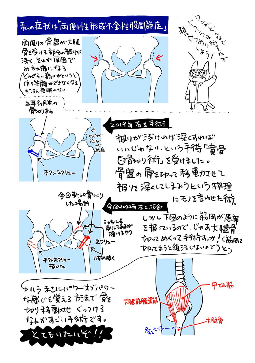 今回なんもツイートせずに入院手術してしまったにも関わらず多くの方にご心配や励ましの言葉、いいねをいただきありがたい限りです。
股関節が激痛で手術が最善の方法であったので入院手術し整形外科にお世話になっています。
経過は鬼のように順調です。ありがとうございます。 